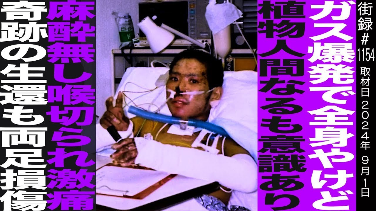 ガス爆発で全身やけど/植物人間になるも意識あり/麻酔なし激痛手術/奇跡の生還も両足損傷/濱安高信