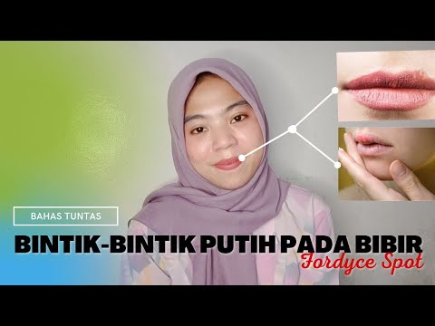 Video: Apakah bintik fordyce akan hilang?