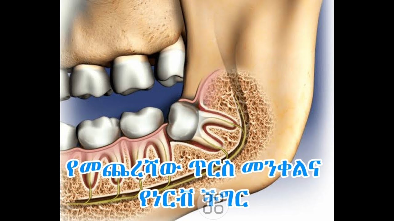 የመጨረሻው ጥርስ ስነቀል ሊይስከትል የሚችለው ችግር/ ለማስነቀል ምን አይነት ሀኪም የመረጣል