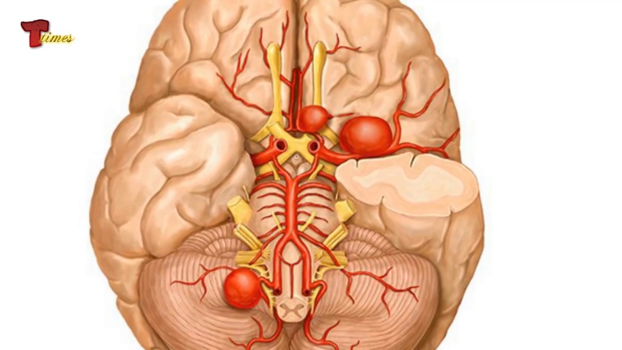 Артерии мозга симптомы. Аневризма мозжечковой артерии. Аневризма головного мозга. Аневризму сосудов головного мозга.