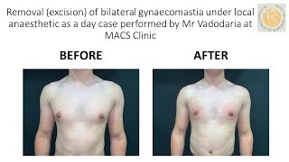 Before & After Removal (excision) of bilateral gynaecomastia