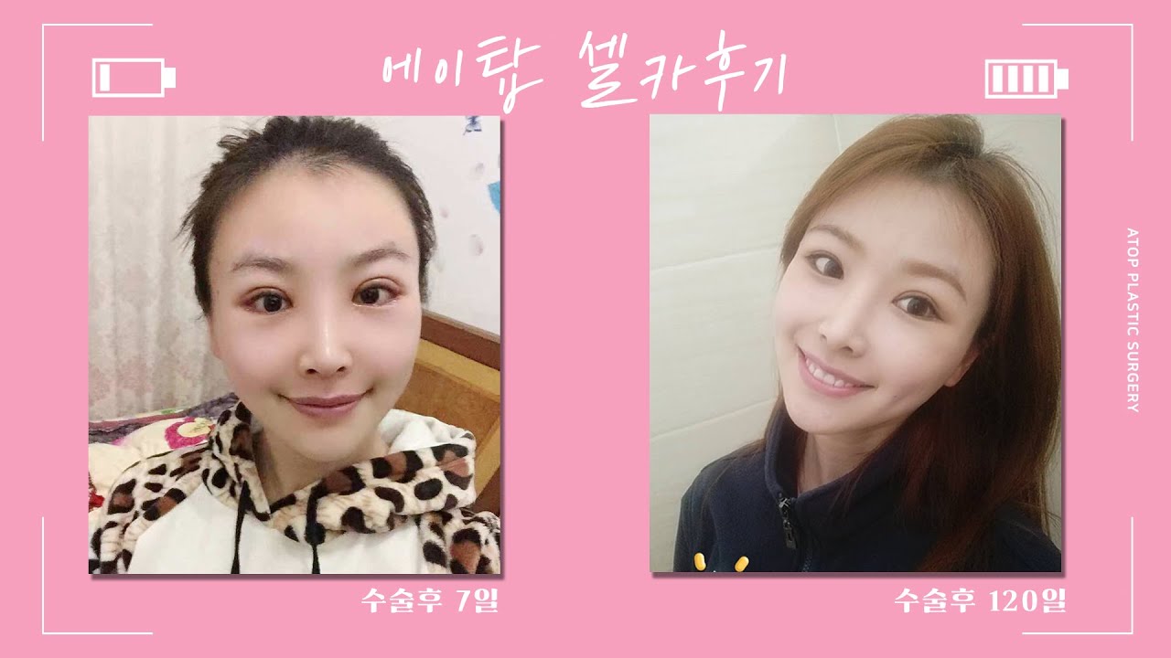 [エートップ整形外科] 【ATOP】目鼻整形リアル自撮りレビュー ★顔立ちがはっきりしていたら嬉しいです〜/エートップ整形外科/ATOP整形外科