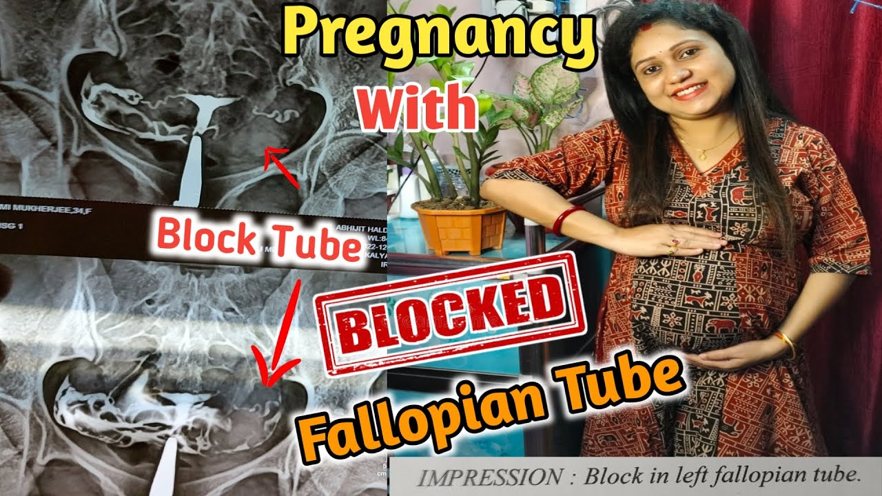 Miracle Pregnancy With Blocked Fallopian Tubes Pregnancy With Blocked Fallopian Tubes || Can You Get Pregnant With