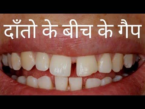 वीडियो: चिपके हुए दांत की सुरक्षा कैसे करें (चित्रों के साथ)