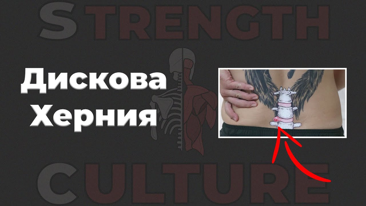Как да се справим с дискова херния