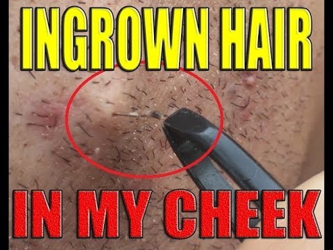 This happened to Me Having an Ingrown Hair In My cheek Extracted 4K Ultra High Definition