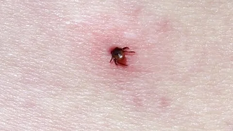 How to Treat Tick Bites Naturally -  Tick Bites Natural Cure