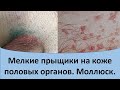 Мелкие прыщики на коже половых органов.  Моллюск.