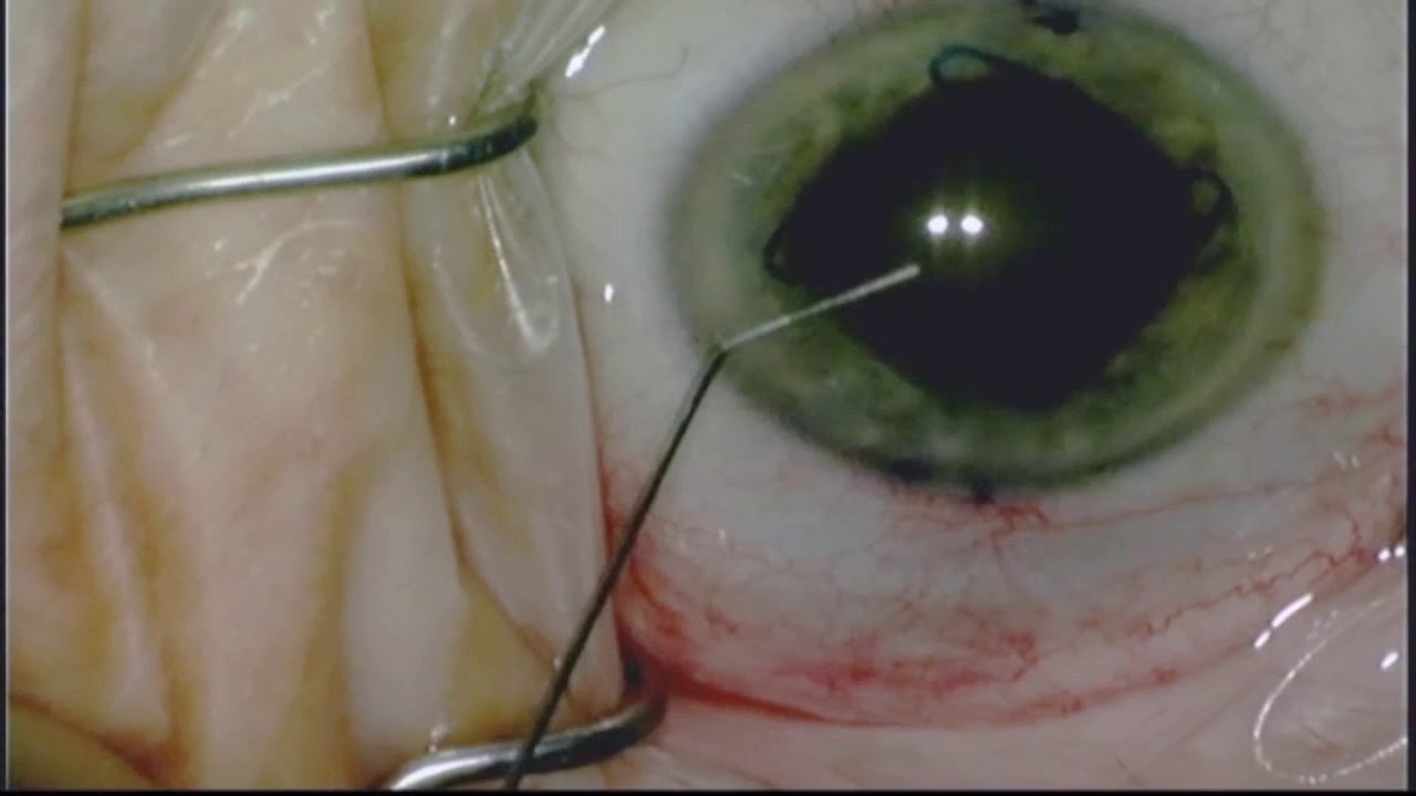 Case 2 Cataract Surgery Wound Burn 
