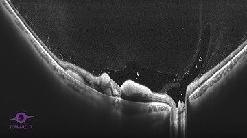Leukemic Retinal Hemorrhage radial lines, from TowardPi 400KHz SS-OCT system: BMizar