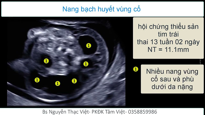 Nang bạch huyết vùng cổ thai nhi trên Webtretho