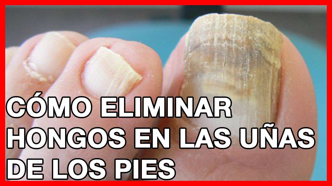 Que es bueno para los hongos de los pies