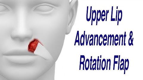 Upper Lip Cancer Excision with Advancement & Rotation Flap Reconstruction