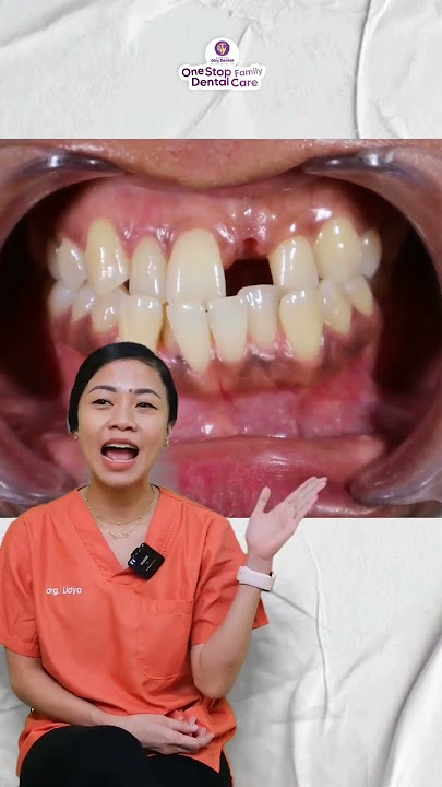 Gigi ompong bisa dibehel?