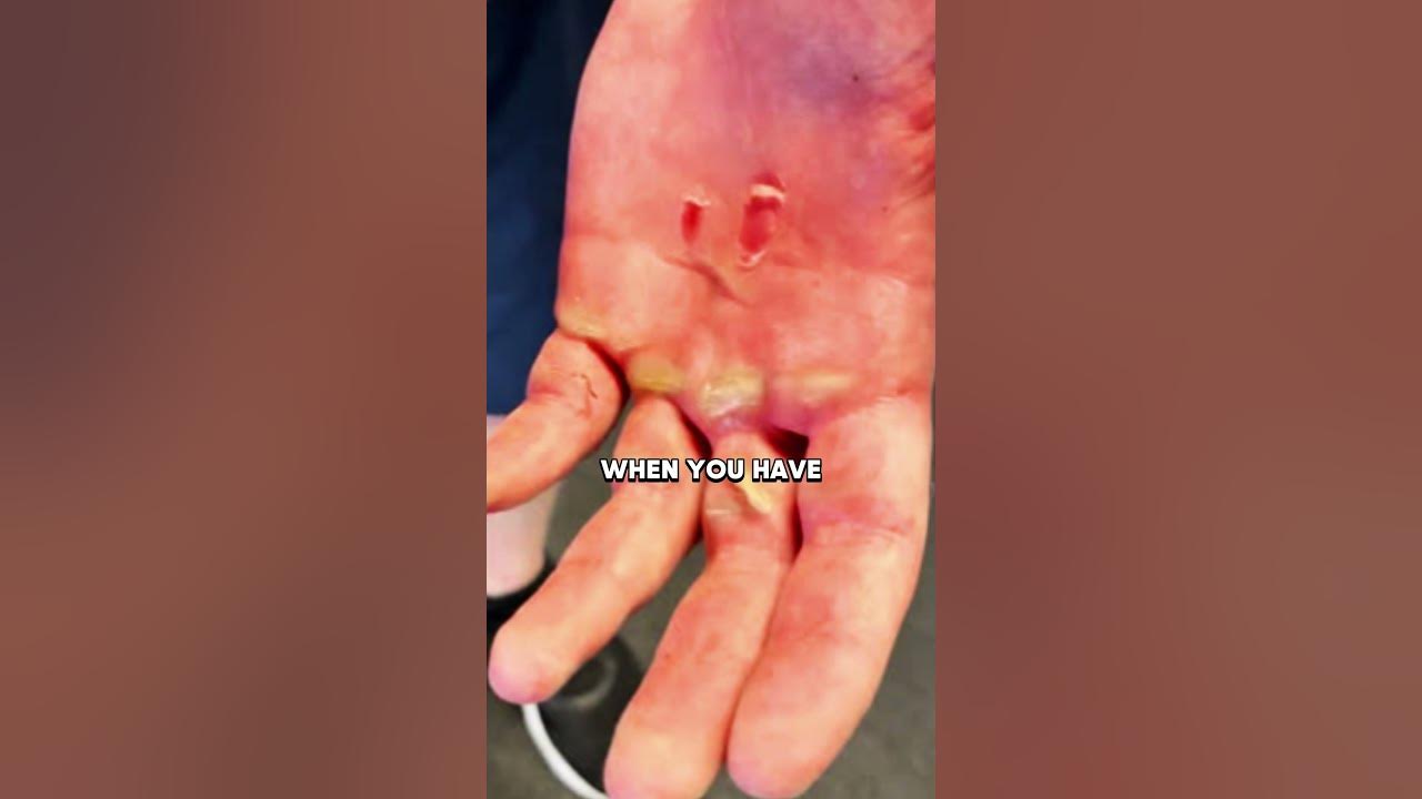 David goggins destroyed his hands doing pull ups youtube