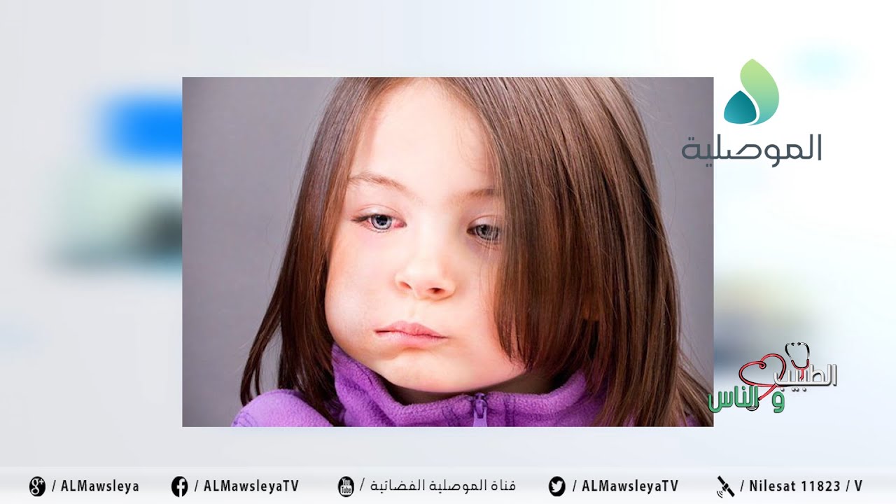 الطبيب والناس ـ التهاب الغدة النكافية