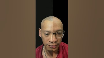 Thay đổi, trước và sau xăm tóc hói