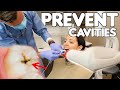 5 Simple Ways To Prevent Cavities