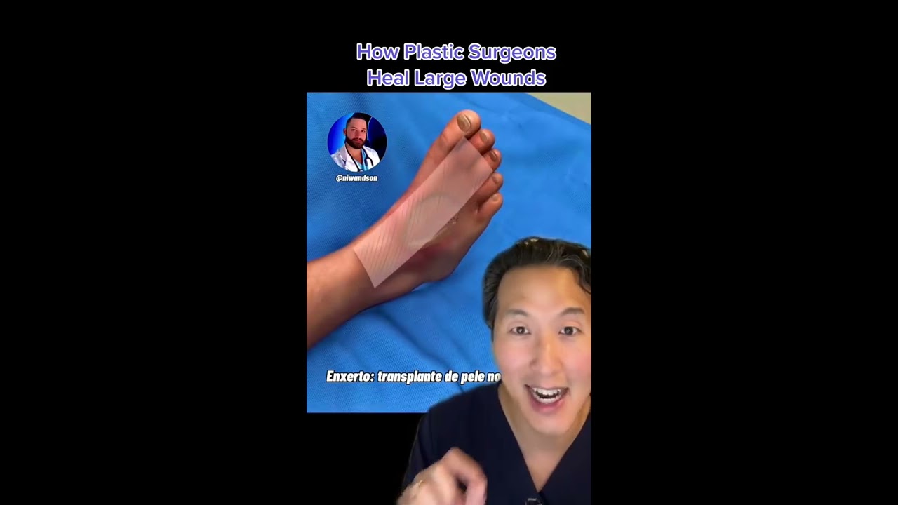 This Is How Plastic Surgeons Heal Large Wounds Shorts Skingraft