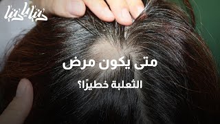 مرض الثعلبة أسبابه والعلاجات المتاحة - دنيا يا دنيا #مرض #طب #الثعلبة