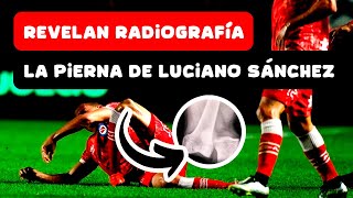 Revelan radiografía de cómo quedó la pierna de 💥 Luciano Sánchez 😮