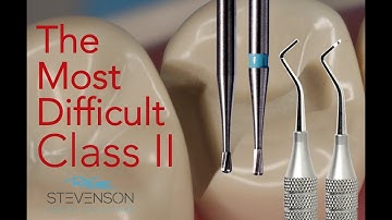 The Most Challenging Class II Amalgam Preparation - Columbia #4 DO