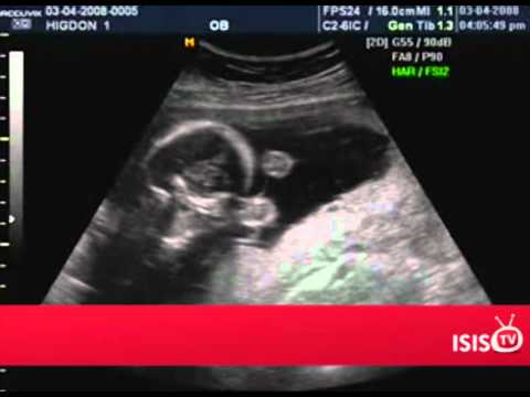 Video: ❶ Cum Să Rămâi însărcinată Cu Gemeni / Crește-ți șansele, Cauzele Gemenilor, Modalitățile De A Rămâne însărcinată