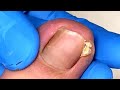 So much nail old skin hiding under toe and need to well clean it【Xue Yidao】