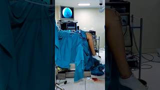 Cruciate Ligament operation #ytshorts #youtubeshorts #aclrecovery #aclinjury #acloperatiinshorts