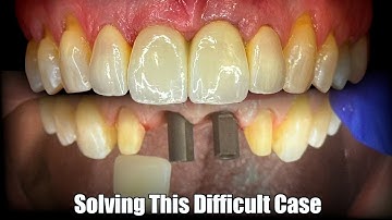 Solving a Difficult Central, Anterior Implant Case with EnvisionTEC