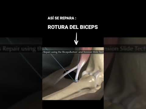 Vídeo: Què és la cirurgia de bíceps?