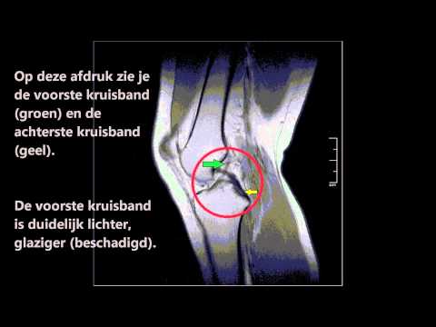 MRI scan van een geblesseerde knie