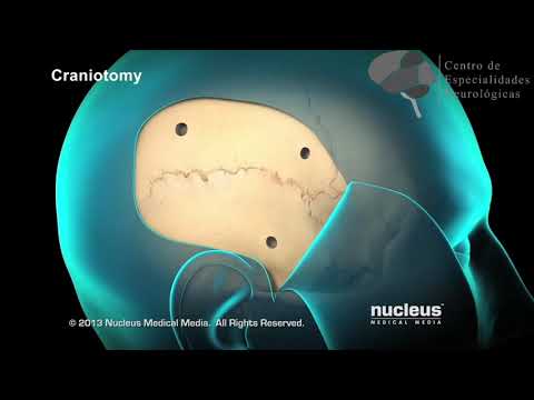 Video: ¿Cuál de los siguientes procedimientos requiere una craneotomía?