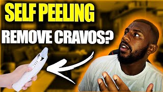 Self Peeling: Self Peeling Removedor de Cravos e Espinhas Funciona? Vale a Pena Comprar Self Peeling