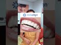 Jom Tanya Dr : I Pernah Pakai Braces, Gigi Jarang Balik, Pakai Brace Lagi? #allsmiledentalspecialist
