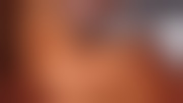 Robotic Right Colectomy  with ICA