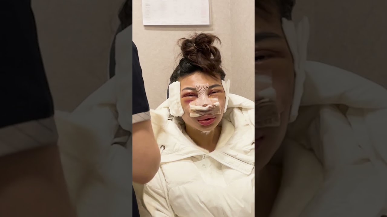 Undergoing A Facial Contouring Surgery In Korea 