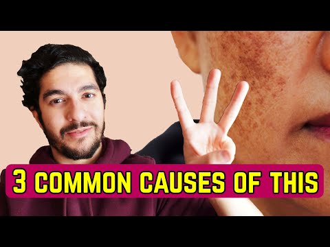 वीडियो: त्वचा पर काला धब्बा क्या होता है?