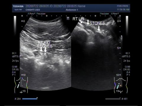 سونوگرافی کلیوی آتروفیک با سنگ کلیه و حالب را نشان می دهد.