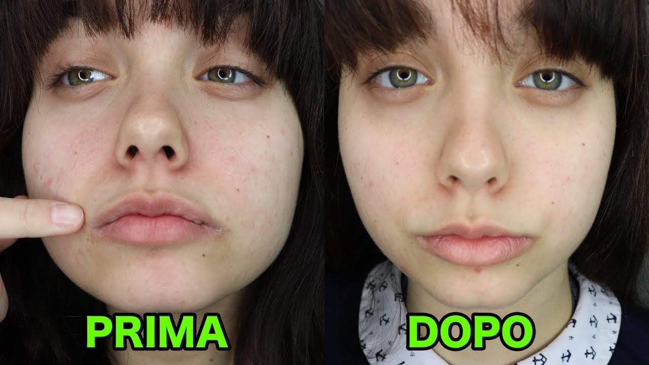 PRIMA E DOPO: L'acido glicolico fa davvero diminuire l'acne? | La mia