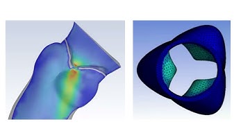 Aortic Valve Displacement CFD Simulation by ANSYS Fluent
