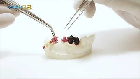 Partial Denture Restoration: Ot Unilateral Attachment