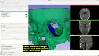 Orbital Surgery Plate Model Registration and Fit Comparison Tutorial 4: editing registered plate