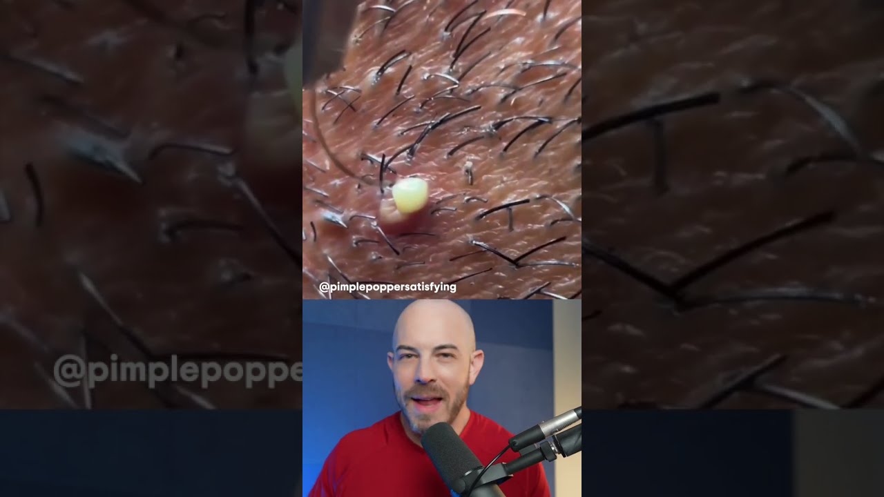 Juicy Ingrown Hair Removal Dermreacts Doctorreacts Ingrownhair