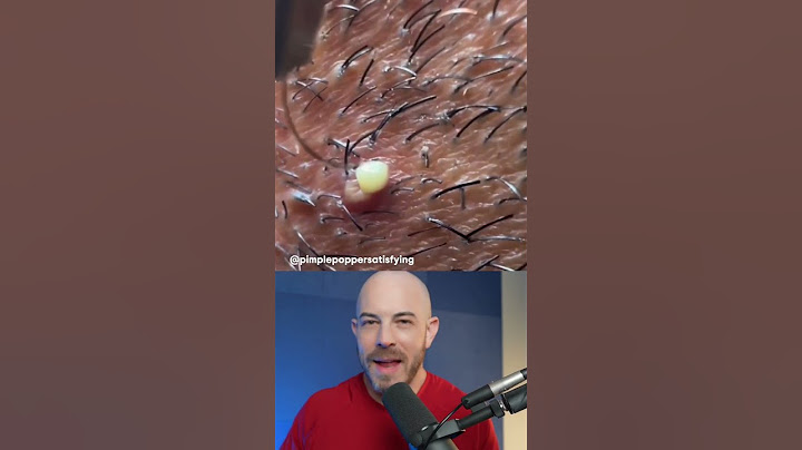 Juicy ingrown hair removal! #dermreacts #doctorreacts #ingrownhair