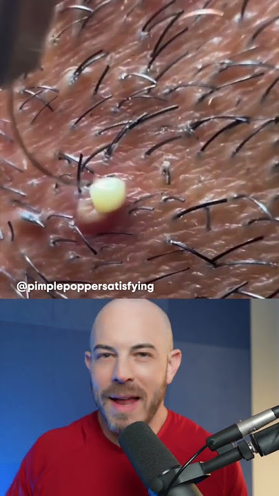Juicy ingrown hair removal! #dermreacts #doctorreacts #ingrownhair