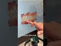#invisalign  Provider #fortlauderdale  Lauderdale Case Study Before and After