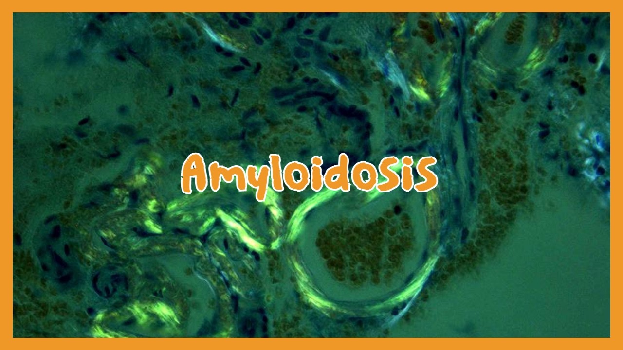 Амилоидоз