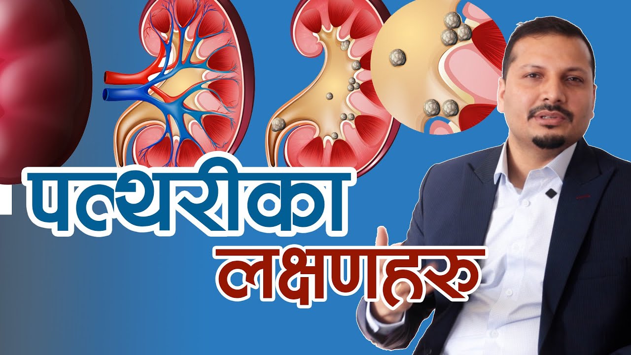 मिर्गौलाको पत्थरीका लक्षणहरु यस्ता पनि हुन्छन्। Niko Nepal _ Dr Chandra Shekhar Yadav