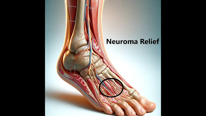 How to solve a Morton's Neuroma